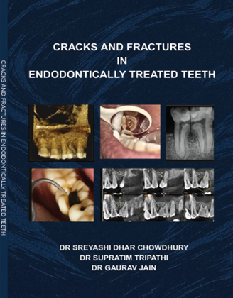 Cracks and Fractures In Endodontically Treated Teeth