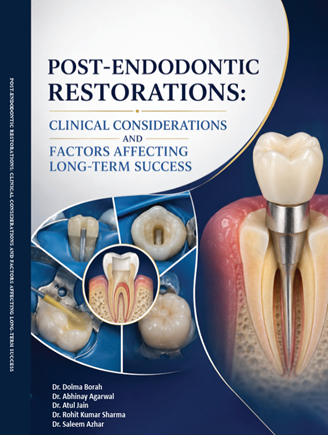 Post-Endodontic Restorations Clinical Considerations and Factors Affecting Long-Term Success